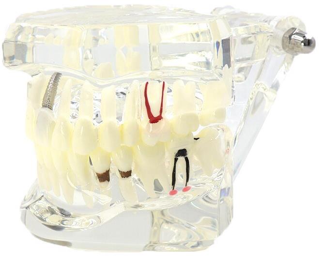 Verk 01964 Model zubných implantátov biela