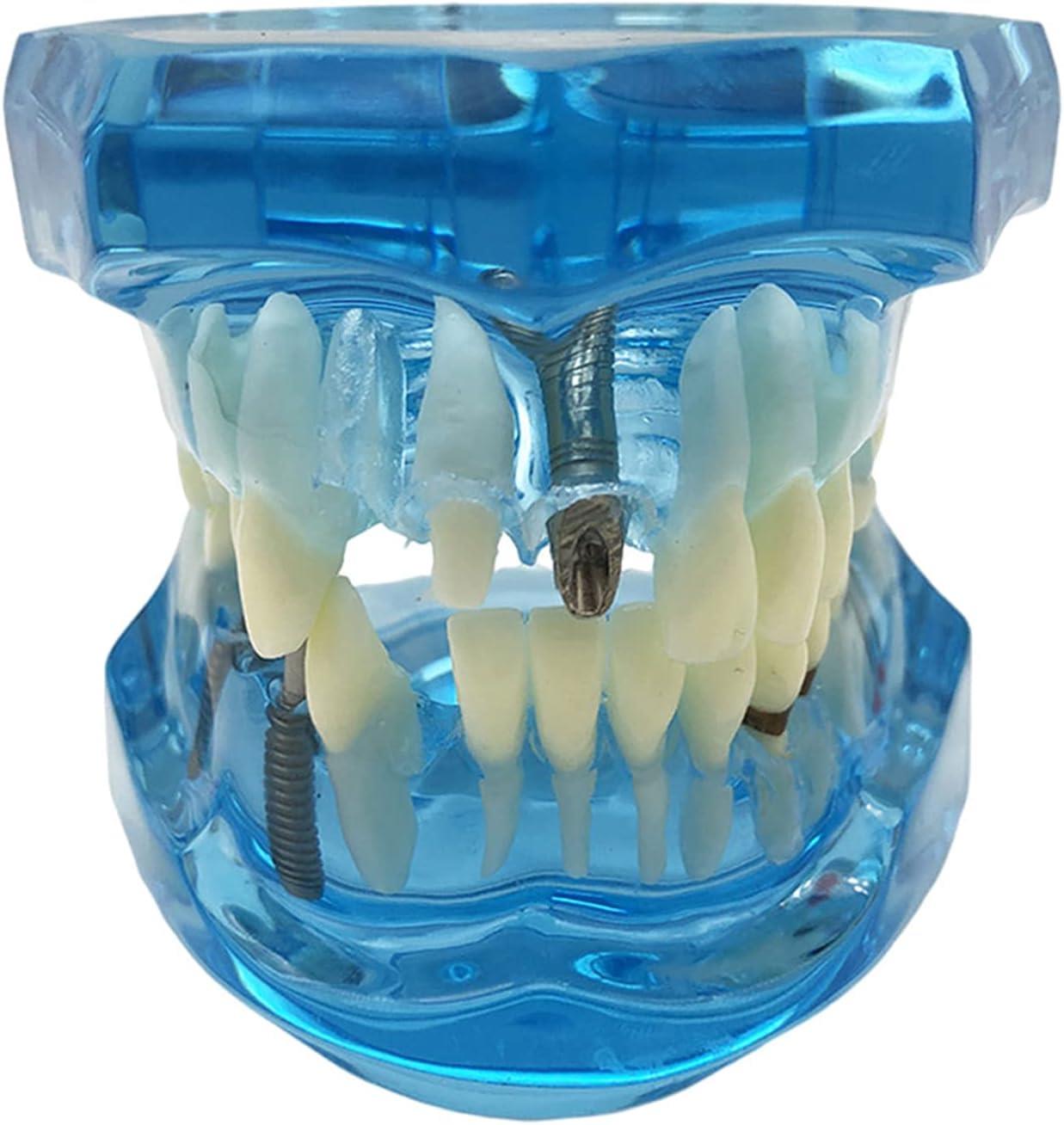Verk 01964 Model zubných implantátov, modrý